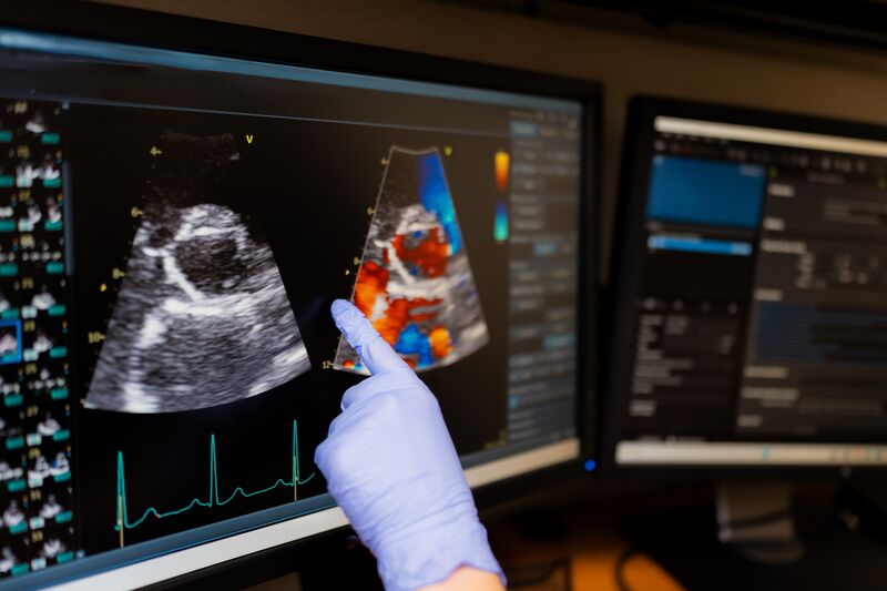 Echocardiogram ultrasound display showing heart imaging with colour Doppler